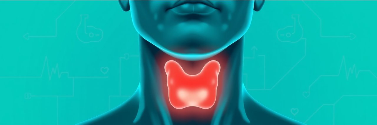 Medical illustration of an underactive thyroid gland in the human neck.